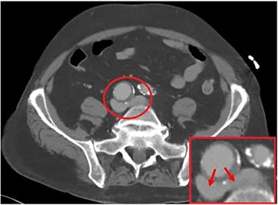 Case Report: It's not always about the veins; intervention of bilateral May–Thurner Syndrome secondary to iliac aneurysm